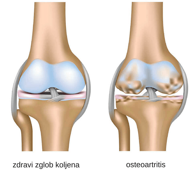 kvantna terapija u liječenju artroze koljena
