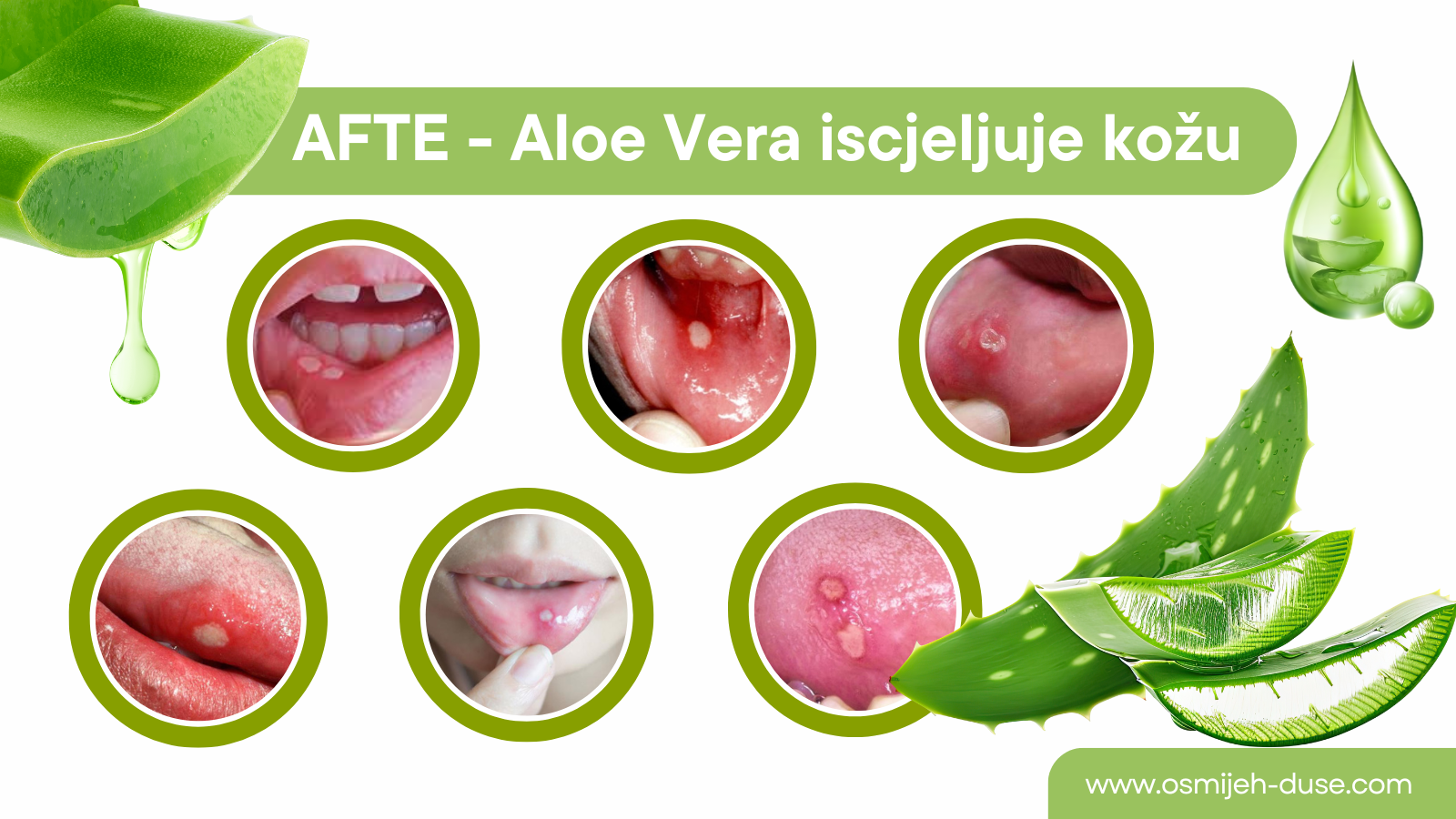 Afte i prirodno rješenje